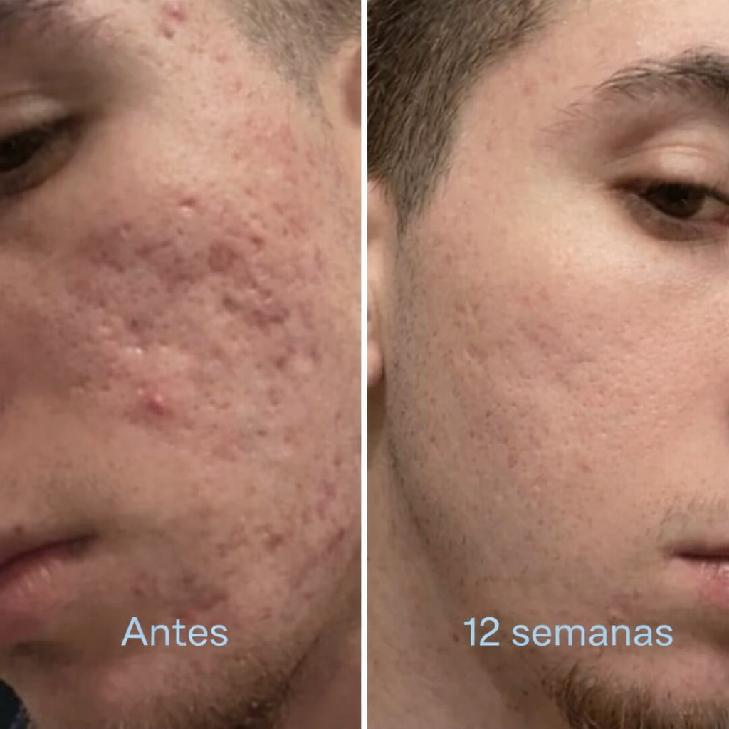 Barra Clínica para Cicatrices