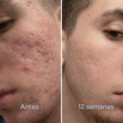 Barra Clínica para Cicatrices